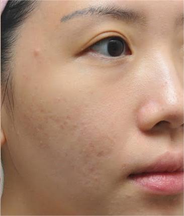 After treatment