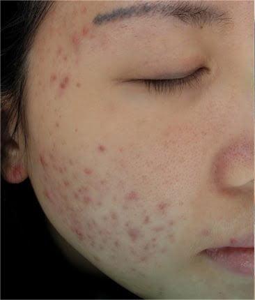 Before treatment